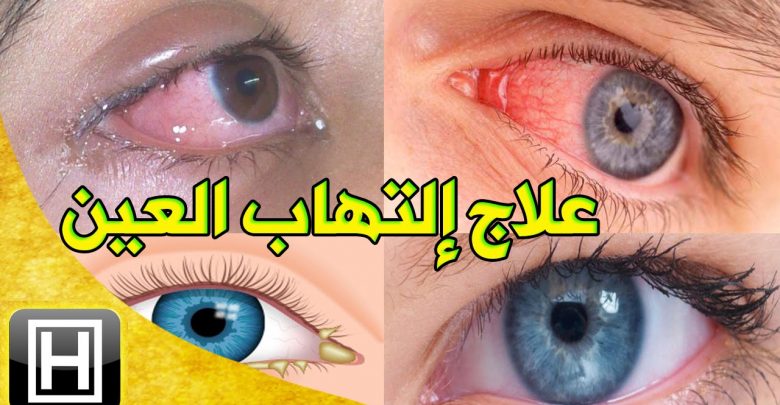 علاج التهاب العين وأعراضه واسباب الاصابة به 