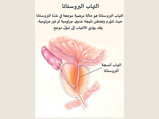  التهاب البروستاتا 